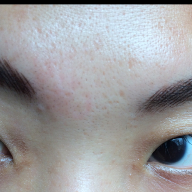 Zits Between The Eyes Remove For Nose Blackheads ...