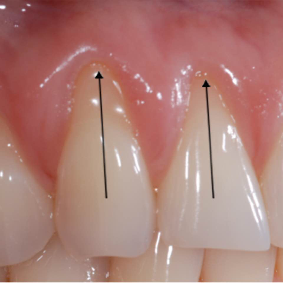 Teeth whitening cost how much